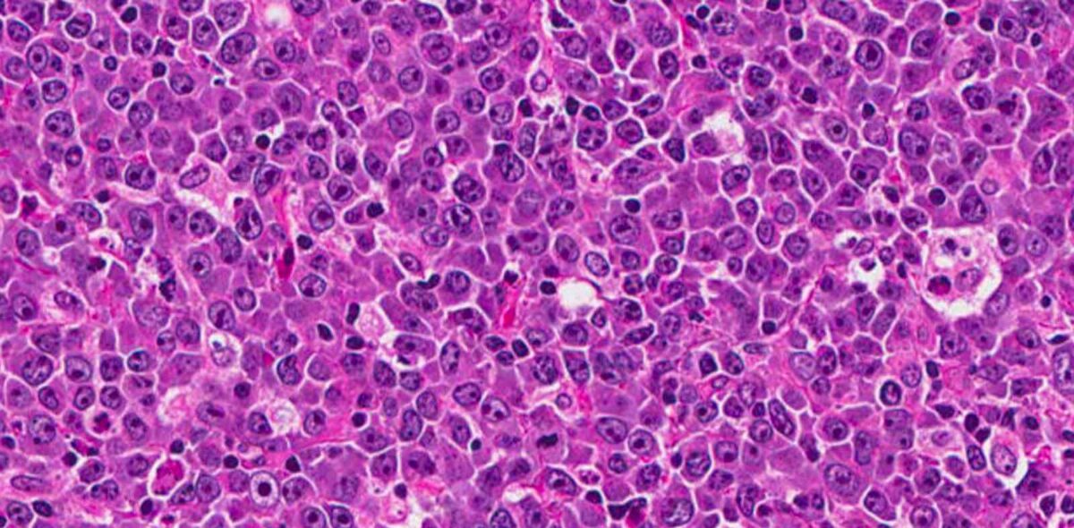 linfoma pacc poliambulatorio collecchio parma