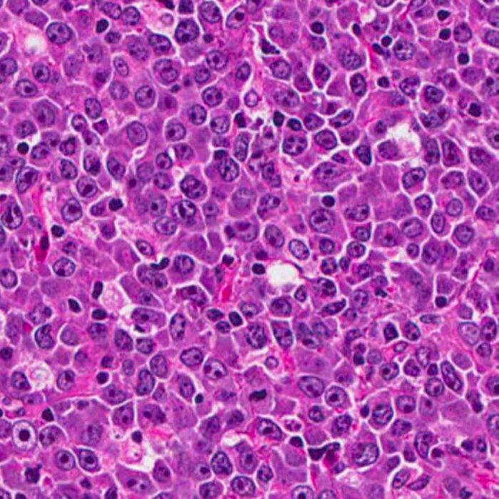 linfoma pacc poliambulatorio collecchio parma